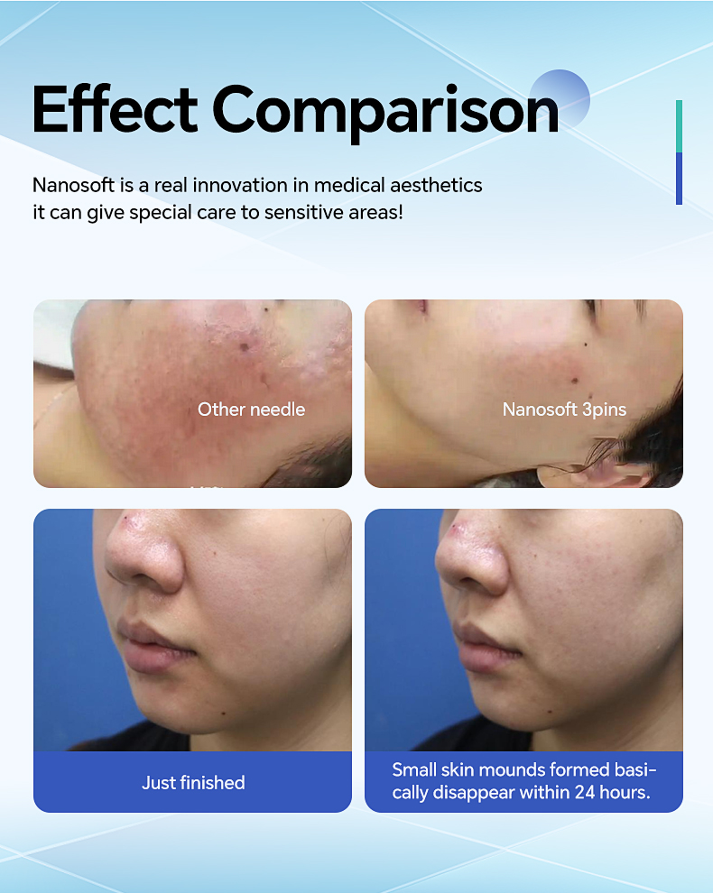 Nanosoft 3pin Microneedle 34G Disposable Sterile Microneedles for Skinbooster Injection