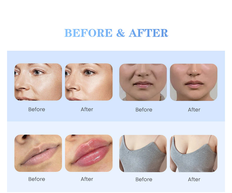 Auro Secret Hyaluronic Acid Filler for Lip Filler Under Eye Nasolabial Folds Cheek Filler