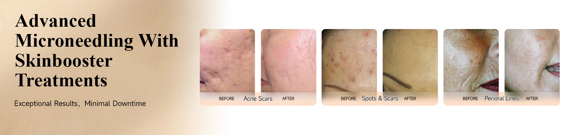 Microneedles, Skinboosters, Microneedle 3/4/5/9pins, Dermal Roller, Mesotherapy Injector, Dr.pen, Dr.pen Cartridges, Hydra Pen, Promotion - Shijiazhuang Auro Technology Limited