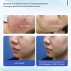 Nanosoft 3pin Microneedle 34G Disposable Sterile Microneedles for Skinbooster Injection